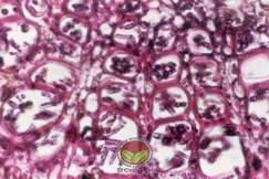 Simptom Penyakit Mati Rosot Vaskular (VSD)